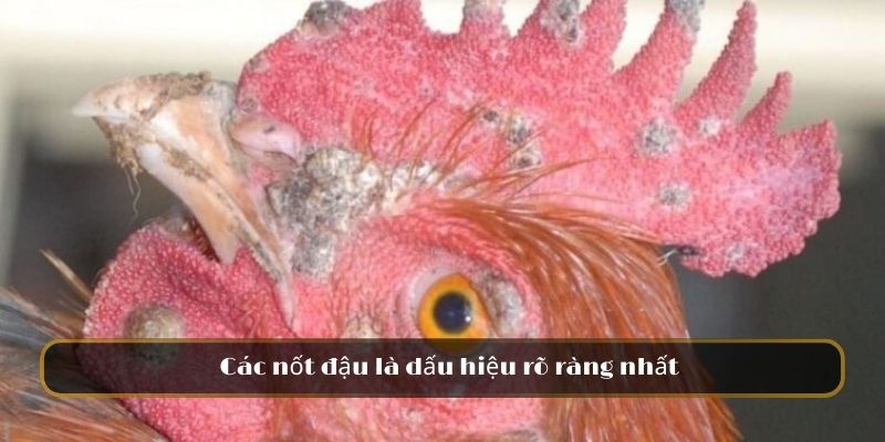 Các nốt đậu là dấu hiệu rõ ràng nhất